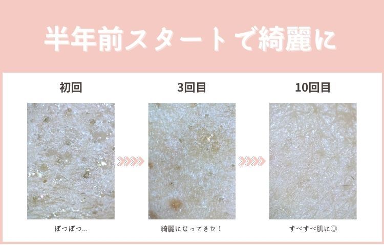 ブライダル脱毛はいつから？